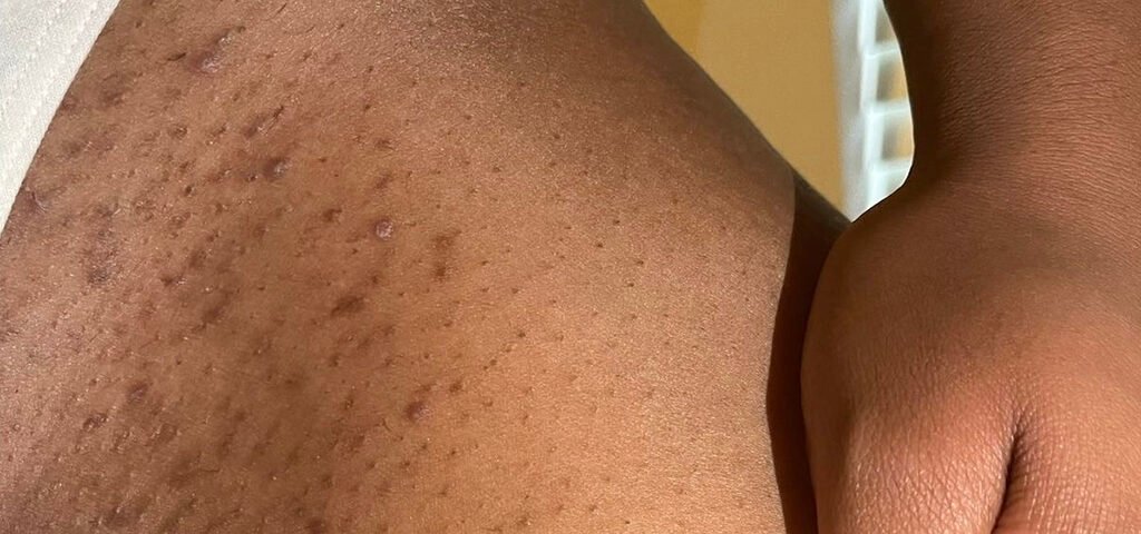 Borba sa tamnim pigmentnim flekama