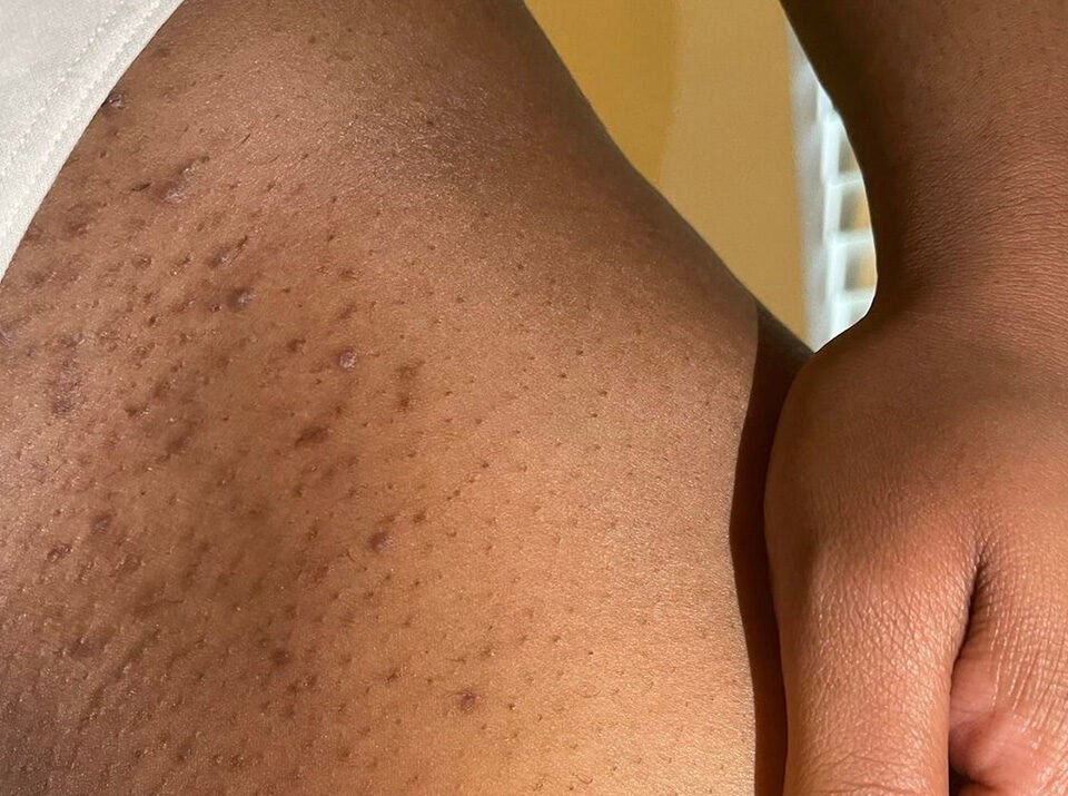 Borba sa tamnim pigmentnim flekama